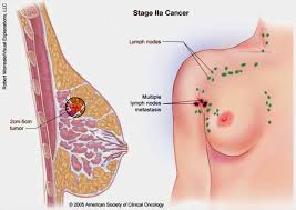 Obat Tumor payudara